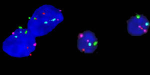 Nachweis von Chromosomenveränderungen im Nierenzellkarzinom mit Hilfe der Fluoreszenz-in-situ-Hybridisierung, Bild 1: gesunde Zelle, Bild 2: Tumorzelle mit Veränderungen auf den Chromosomen 1 (blau), 2 (rot) und 6 (grün). Bild: UKJ 