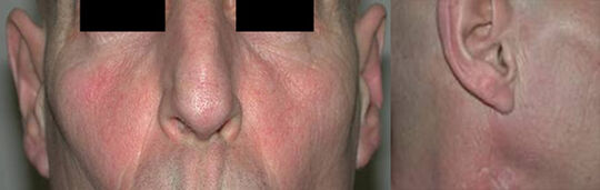 Zustand 1 Jahr nach Entfernung der Ohrspeicheldrüse rechts und Defektfüllung mit Bauchfett.