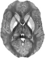 Suszeptibilitätskartierung eines gesunden menschlichen Gehirns. Quelle: AG Medizinische Physik , UKJ