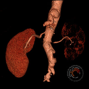 Die Angiographie-Aufnahme zeigt deutlich, wie eine Vaskulitis die großen zuführenden Gefäße der Niere bis zum Funktionsverlust des Organs schädigen kann. Bild: Nuklearmedizin/UKJ 