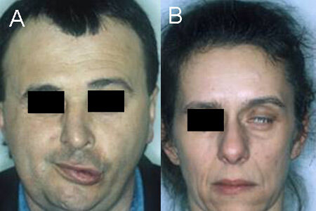 Facelift bei Gesichtslähmung und Fazialisparese